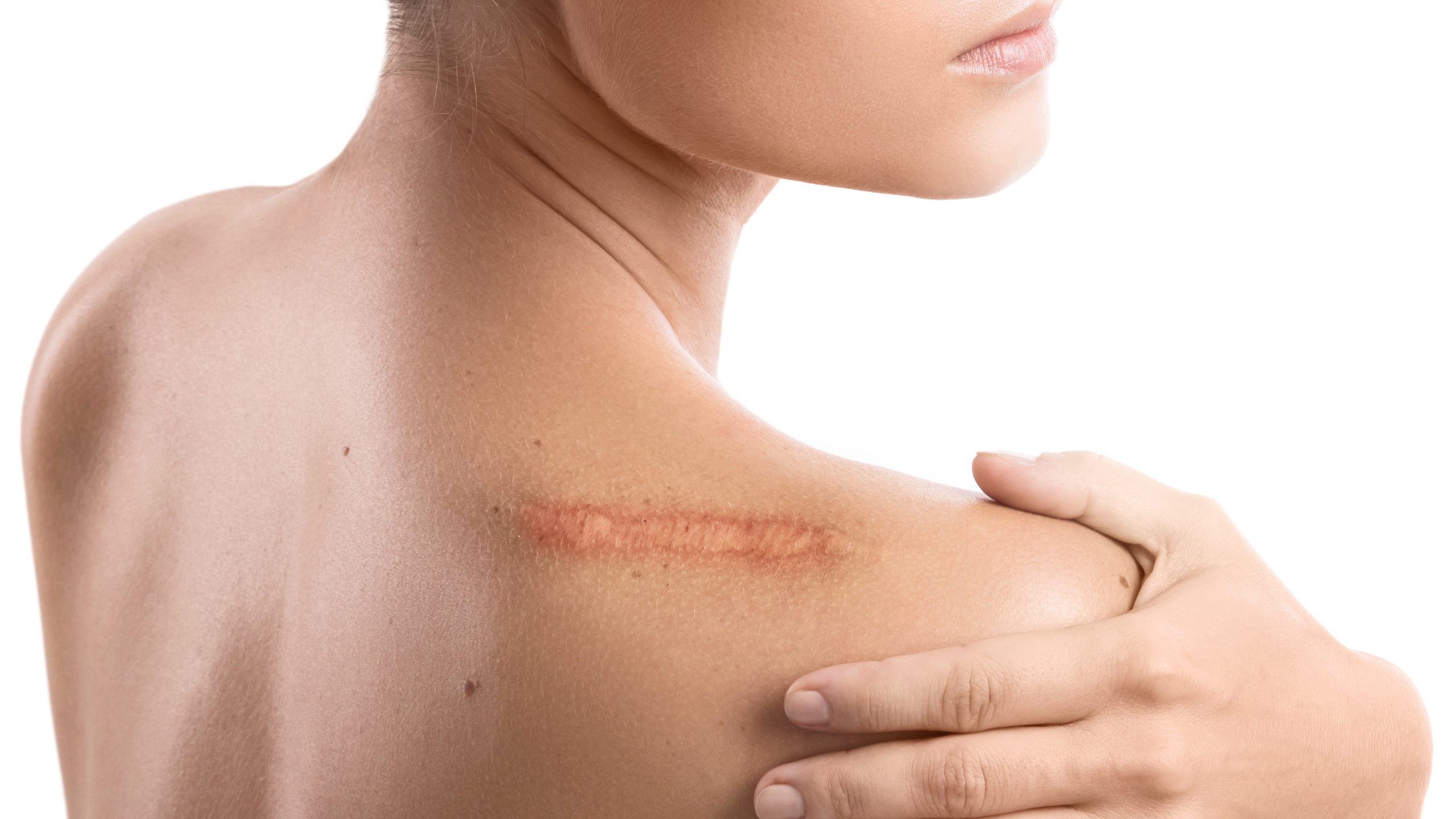 Scars Don’t Just Go Away in One Treatment