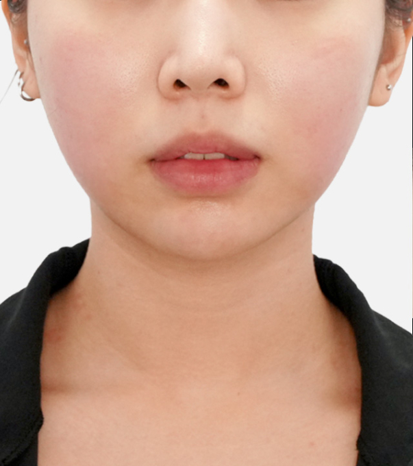 InMode 术后 第3次