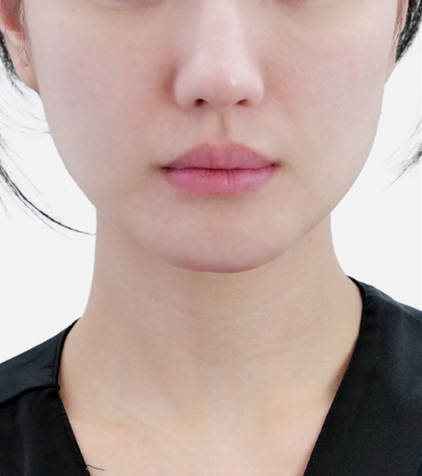 Density 术后 25.08.11