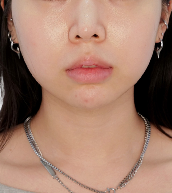 InMode 术前 25.02.11