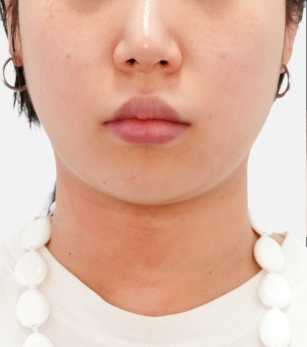 InMode 术前 25.10.22