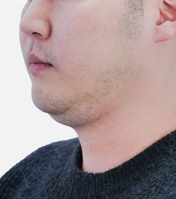 Shrink 术前 25.06.01
