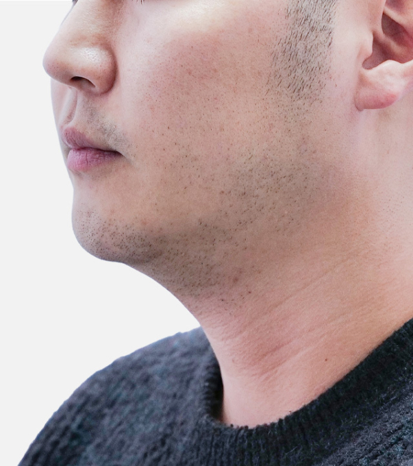Shrink 术后 25.06.01